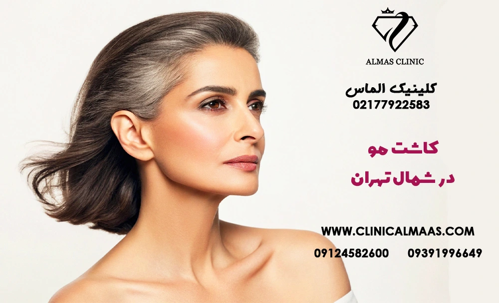 کاشت مو در شمال تهران